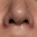 小鼻縮小（切開） キップン整形外科 DAY 7 サムネイル用