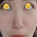 鼻尖形成（切開） / 軟骨移植 白山クリニック 大分 DAY 12 サムネイル用