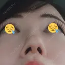 鼻尖形成（切開） / 軟骨移植 白山クリニック 大分 DAY 12 サムネイル用