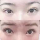 二重埋没 湘南美容クリニック 松山院 DAY 0 サムネイル用