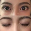 二重切開 ルネッサンス美容外科医院 神戸院 DAY 181 サムネイル用