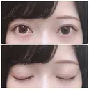 二重切開 / 上まぶたたるみ取り / 上まぶたの脂肪取り 銀座高須クリニック DAY 492 サムネイル用