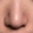 小鼻縮小（切開） キップン整形外科 DAY 8 サムネイル用