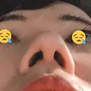 鼻尖形成（切開） / 軟骨移植 白山クリニック 大分 DAY 13 サムネイル用