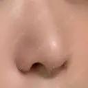 小鼻縮小（切開） キップン整形外科 AFTER サムネイル用