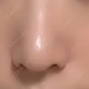 小鼻縮小（切開） キップン整形外科 DAY 9 サムネイル用