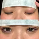 二重埋没 湘南美容クリニック 松山院 AFTER サムネイル用