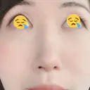 鼻尖形成（切開） / 軟骨移植 白山クリニック 大分 DAY 14 サムネイル用