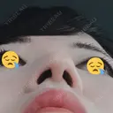 鼻尖形成（切開） / 軟骨移植 白山クリニック 大分 DAY 14 サムネイル用