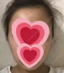 バッカルファット除去 / 脂肪吸引（顔） / ヒアルロン酸注入（あご） / ボトックス（エラ・小顔） エートップ美容整形外科 DAY 32 サムネイル用