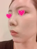 クマ治療 / 額を丸く / 脂肪吸引（脚） / レディエッセ注入（鼻） THE CLINIC（ザ・クリニック） 東京院 DAY 8 サムネイル用