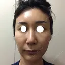 鼻尖形成（切開） / 糸リフト / 目尻切開 / こめかみ形成 / 肌ヒアルロン酸注入（たるみ・シワ改善） / ヒアルロン酸注入（あご） / ヒアルロン酸注入（唇） あきこクリニック DAY 31 サムネイル用