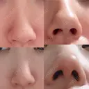 鼻尖形成（切開） / 軟骨移植 白山クリニック 大分 AFTER サムネイル用