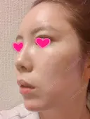 クマ治療 / 額を丸く / 脂肪吸引（脚） / レディエッセ注入（鼻） THE CLINIC（ザ・クリニック） 東京院 DAY 10 サムネイル用