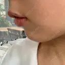 ヒアルロン酸注入（唇） リエンジャン整形外科 弘大店 DAY 0 サムネイル用