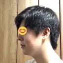 ほくろ・いぼ切除（肌） 大西皮フ科形成外科医院 京都四条烏丸院 DAY 176 サムネイル用