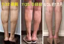 ボトックス（ふくらはぎ） REYOUNGクリニック DAY 35 サムネイル用