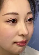 二重埋没 / 目頭切開 / 鼻尖形成（切開） / 鼻中隔延長（切開） / 軟骨移植 / ヒアルロン酸注入（鼻） / ヒアルロン酸注入（あご） 湘南美容クリニック 新潟院 DAY 32 サムネイル用