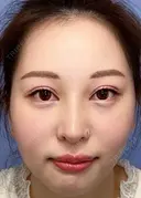 二重埋没 / 目頭切開 / 鼻尖形成（切開） / 鼻中隔延長（切開） / 軟骨移植 / ヒアルロン酸注入（鼻） / ヒアルロン酸注入（あご） 湘南美容クリニック 新潟院 DAY 32 サムネイル用