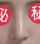 鼻尖形成（切開） / 鼻中隔延長（切開） / 軟骨移植 / 骨切幅寄せ / ワシ鼻修正・ハンプ切除 / 眉間プロテーゼ グロービー美容整形外科 DAY 22 サムネイル用