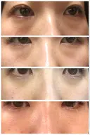 クマ治療 / 下まぶたたるみ取り / 下まぶたの脂肪取り コスメディカルクリニック シンシア 渋谷院 DAY 7 サムネイル用