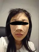 隆鼻術 / 小鼻縮小（切開） 湘南美容クリニック 熊本院 AFTER サムネイル用