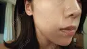 ニキビ治療 The Beauty Clinic SENDAI DAY 1 サムネイル用