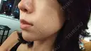 ニキビ治療 The Beauty Clinic SENDAI DAY 1 サムネイル用