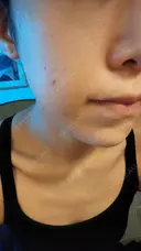 ニキビ治療 The Beauty Clinic SENDAI DAY 3 サムネイル用