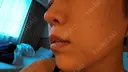ニキビ治療 The Beauty Clinic SENDAI DAY 3 サムネイル用