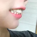 セラミック 湘南歯科クリニック 新宿院 DAY 145 サムネイル用