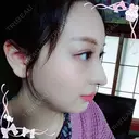 二重埋没 / 目頭切開 / 鼻尖形成（切開） / 鼻中隔延長（切開） / 軟骨移植 / ヒアルロン酸注入（鼻） / ヒアルロン酸注入（あご） 湘南美容クリニック 新潟院 DAY 13 サムネイル用