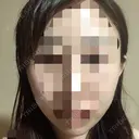 骨切り（あご） / 骨削り（エラ） / 骨削り（頬） ボンディ美容整形外科（旧リオン整形外科） DAY 23 サムネイル用