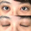 二重切開 / 目頭切開 / ほくろ・いぼ切除（肌） / 上まぶたたるみ取り / 上まぶたの脂肪取り 東京美容外科 銀座院 DAY 131 サムネイル用