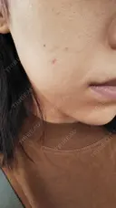 ニキビ治療 The Beauty Clinic SENDAI DAY 4 サムネイル用
