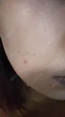 ニキビ治療 The Beauty Clinic SENDAI DAY 4 サムネイル用