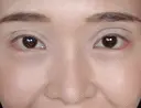 二重切開 / 目頭切開 / 眼瞼下垂（切開） / 隆鼻術 / 目尻切開 / 上まぶたたるみ取り / 軟骨移植 湘南美容クリニック 岡山院 DAY 28 サムネイル用