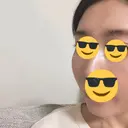 骨削り（頬） / 輪郭修正 マックスファクス銀座クリニック DAY 31 サムネイル用