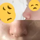 隆鼻術 / 鼻中隔延長（切開） 牧野皮膚科形成外科内科医院 美容外科・形成外科・抗加齢医学外来 DAY 173 サムネイル用