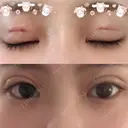 二重埋没 恵聖会クリニック 心斎橋院 DAY 1 サムネイル用