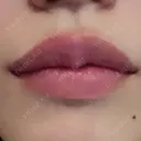 ヒアルロン酸注入（唇） TCB東京中央美容外科 堺院 DAY 0 サムネイル用