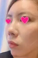 クマ治療 / 額を丸く / 脂肪吸引（脚） / レディエッセ注入（鼻） THE CLINIC（ザ・クリニック） 東京院 DAY 22 サムネイル用