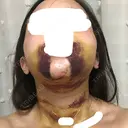 バッカルファット除去 / 脂肪吸引（顔） / ボトックス（あご） / 水光注射（ハリ・美肌） / ヒアルロン酸注入（あご） / ボトックス（エラ・小顔） / 脂肪溶解注射（顔） / ヒアルロン酸注入（唇） エートップ美容整形外科 DAY 7 サムネイル用