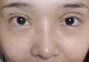 二重切開 / 目頭切開 / 眼瞼下垂（切開） / 隆鼻術 / 目尻切開 / 上まぶたたるみ取り / 軟骨移植 湘南美容クリニック 岡山院 DAY 31 サムネイル用