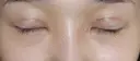 二重切開 / 目頭切開 / 眼瞼下垂（切開） / 隆鼻術 / 目尻切開 / 上まぶたたるみ取り / 軟骨移植 湘南美容クリニック 岡山院 DAY 31 サムネイル用