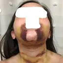 バッカルファット除去 / 脂肪吸引（顔） / ボトックス（あご） / 水光注射（ハリ・美肌） / ヒアルロン酸注入（あご） / ボトックス（エラ・小顔） / 脂肪溶解注射（顔） / ヒアルロン酸注入（唇） エートップ美容整形外科 DAY 8 サムネイル用