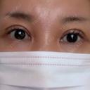 二重切開 / 眼瞼下垂（切開） / 上まぶたたるみ取り 四谷見附クリニック DAY 185 サムネイル用