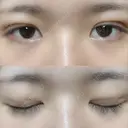 二重埋没 / 眼瞼下垂（切開） アリナガ美容外科 DAY 9 サムネイル用
