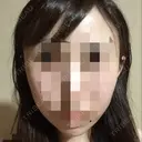 骨切り（あご） / 骨削り（エラ） / 骨削り（頬） ボンディ美容整形外科（旧リオン整形外科） DAY 30 サムネイル用