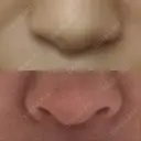 隆鼻術 / 鼻中隔延長（切開） 牧野皮膚科形成外科内科医院 美容外科・形成外科・抗加齢医学外来 DAY 177 サムネイル用